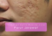 JERAWAT !! Boleh Dihilangkan Secara Agresif Dalam 2 Minggu – Skrub kunyit Ultimate Healing