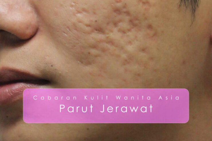 JERAWAT !! Boleh Dihilangkan Secara Agresif Dalam 2 Minggu – Skrub kunyit Ultimate Healing